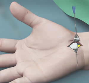 Carpal Tunnel Release Surgery img