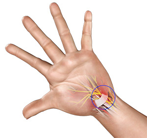 Carpal Tunnel Syndrome img
