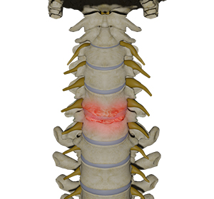 Cervical Degenerative Disc Disease img