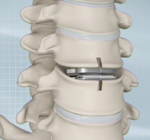 Cervical Disc Replacement img
