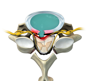 Cervical Laminectomy img