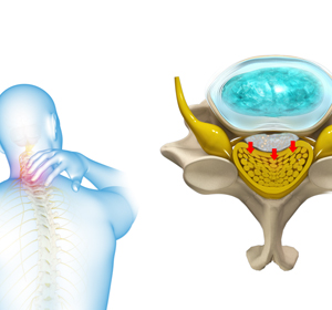 Cervical Myelopathy img