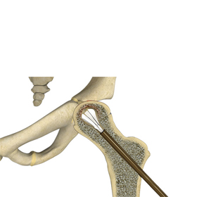 Core Decompression img