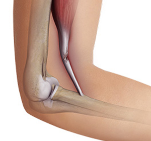 Distal Biceps Injuries img