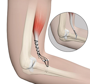 Distal Biceps Repair img