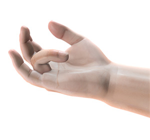 Dupuytren's contracture img