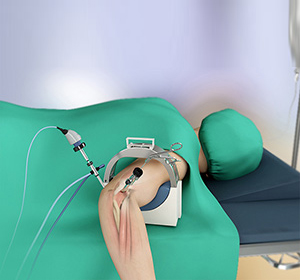 Elbow Arthroscopy img