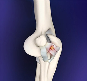 Elbow Ligament Reconstruction img