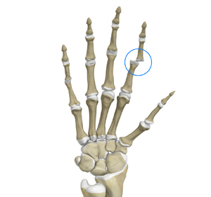 Finger Dislocation img