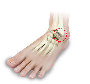 Foot and Ankle Arthritis img