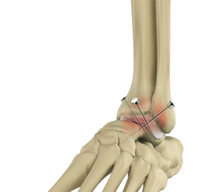 Foot and Ankle Surgery img