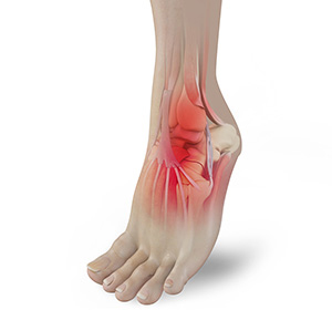 Foot Pain img
