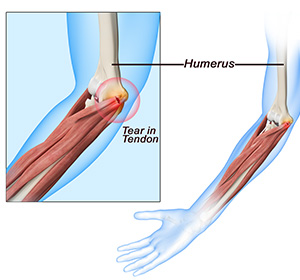 Golfer’s Elbow Surgery img