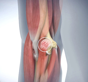 Golfer’s Elbow img