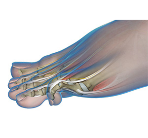 Hammertoe Correction img