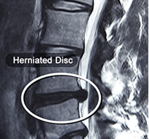 Herniated Disc img