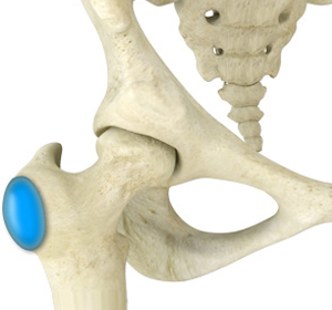 Hip Bursitis img
