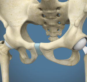 Hip Hemiarthroplasty img