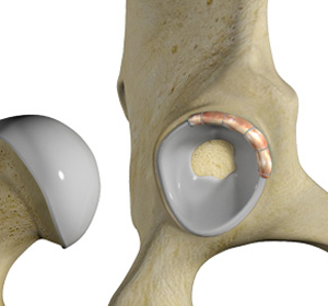 Hip Labral Repair img