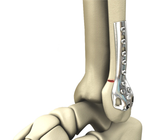 Internal and External Fixation of Foot and Ankle Fractures img