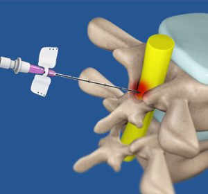 Interventional Pain Management img