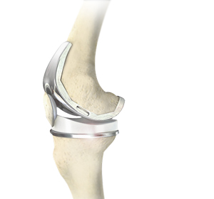 Joint Replacement img