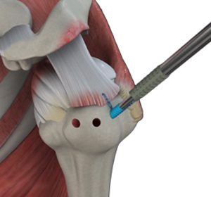 Knee Arthroscopy img