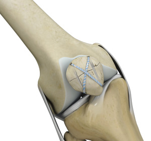 Knee Fracture Surgery img