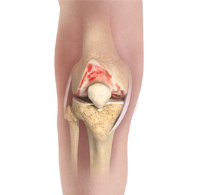 Knee Osteoarthritis img