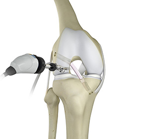 Knee Trauma Reconstruction img