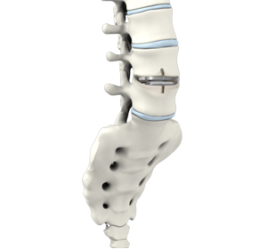 Lumbar Artificial Disc Replacement img