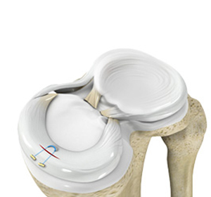 Meniscal Repair Surgery img