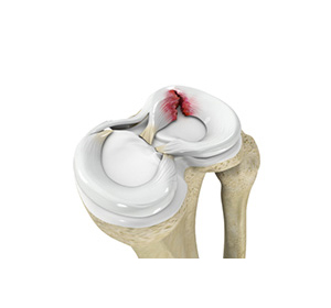 Complex Meniscus Tear img