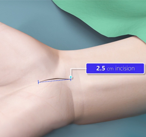 Minimally Invasive Hand img