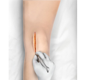 Minimally Invasive Knee Joint Replacement img