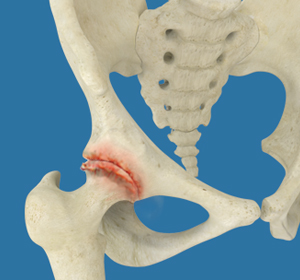 Osteoarthritis of the Hip img