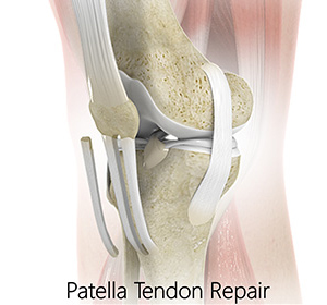 Patellar Tendon Repair img