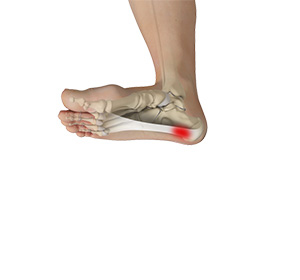 Plantar Fascia Release img