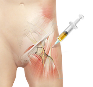 Platelet Rich Plasma (PRP) Injections img