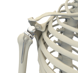 Reverse Shoulder Replacement img