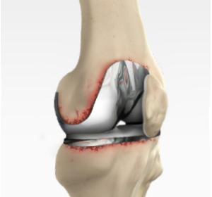 Revision Knee Replacement img