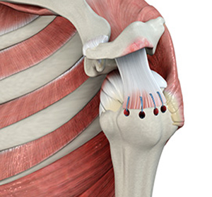 Rotator Cuff Repair img