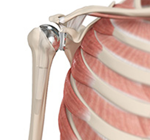 Shoulder Joint Replacement img