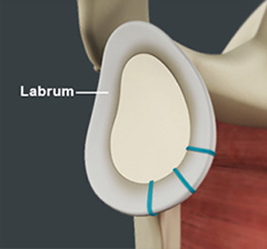 Shoulder Labrum Reconstruction img