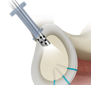 Shoulder Reconstruction Surgery img