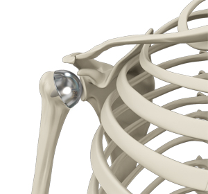 Shoulder Resurfacing img