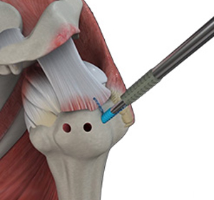 Shoulder Stabilization img