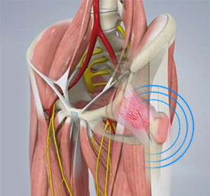 Snapping Hip Syndrome img