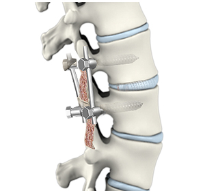 Spinal Fusion img