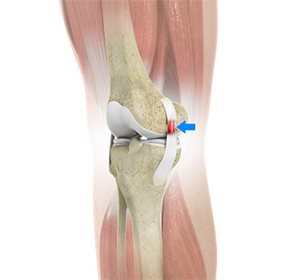 Sprains and Strains img
